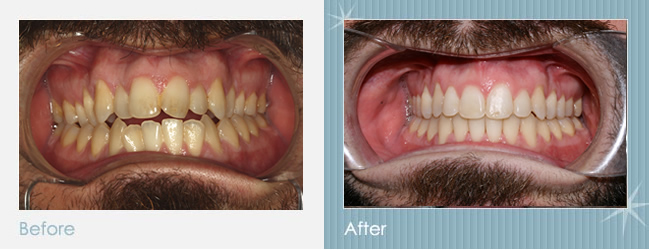 Invisalign Before After Treatment Dental Clinic in Spain | La Garena Invisalign